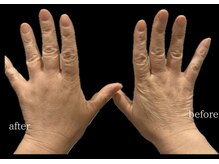 コア チャーム(CORE CHARM)/光フォト