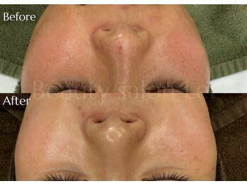 レイ(Lei)/ニキビ/毛穴/ハーブピーリング