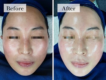 フローラル ビューティー(Floral-Beauty)/【ビフォーアフター】小顔エステ