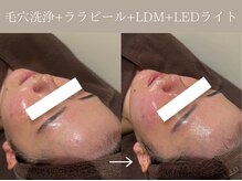 リィ プラス(Riii plus)/毛穴洗浄+ララピール+LDM+LED