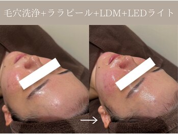 リィ プラス(Riii plus)/毛穴洗浄+ララピール+LDM+LED