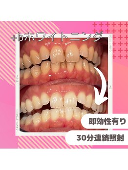 プラスビーセルフ(+b self)/ホワイトニング効果