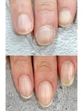 リファーレ(RIFARE)/【深爪矯正】1年後の変化◎