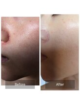 デイジー/グリーンピール（0.5g）毛穴ケア