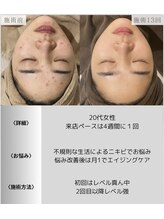 サロンエヌ 久留米店(Salon N)/肌のきめ細かく水分量もアップ