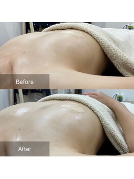 ルミエール(Lumiere)/【倉敷市】バストアップ施術事例