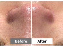 アーキ(ARCHI)/【稲沢/毛穴洗浄】毛穴洗浄