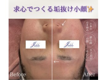 ユフラ(Juhla)/切らない小顔リフト