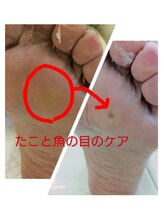 ドクターネイル爪革命 江戸川橋店/魚の目とたこの違いは？