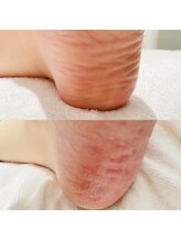 ワイドット(y.)/角質ケアコース