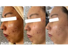 マスカレード(Masquerade)/【クリスティーナ症例写真】