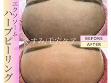 Cスキンケアクリニック 麻布店/ハーブピーリングBeforeAfter