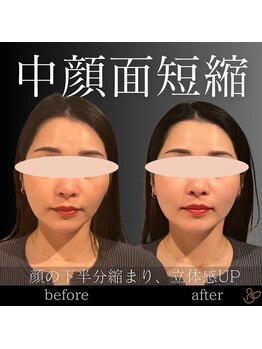 チョコバリ 渋谷店(chocobari)/小顔×リフトアップ(美容鍼)20代