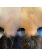 せせらぎ鍼灸院/首肩こり