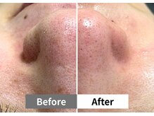 アーキ(ARCHI)/【稲沢/毛穴洗浄】毛穴洗浄