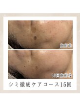 エンルーチェ(enluce)/【天六・梅田】シミケア