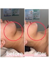 プリマ 大津店(PRIMA)/シュっとした輪郭に★小顔ケア