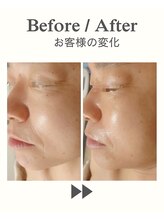 ココプレジール(Cocoplaisir)/たるみ/シワ/ほうれい線