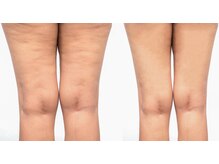 ルミア(LUMIA)/セル脂肪・ガチガチ脂肪を撃退！