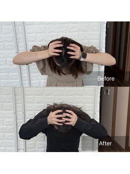 ティエル(Tielu)/小顔矯正6回の変化