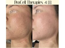 ルチル(Rutile)/プロセルセラピーズフェイシャル