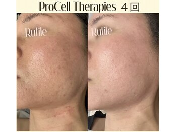 ルチル(Rutile)/プロセルセラピーズフェイシャル