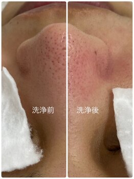 ミスネイル 真玉橋店(Ms.nail)/フェイシャル｜毛穴トラブル予防