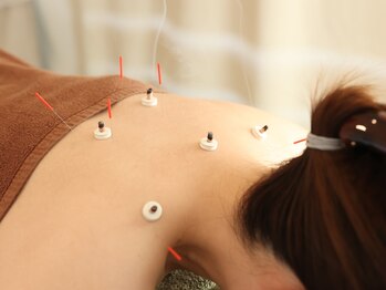 久心宝鍼灸院/お身体の鍼