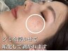 シミケア【20分当て放題】低周波＆美容液導入&マッサージ90分¥12,000→¥8,500
