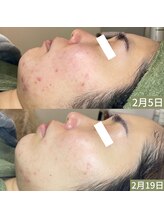 ちらちゅら/クリスティーナ【施術2回】経過