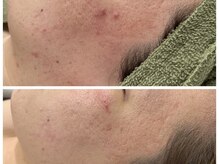 トータルビューティ リライフ(Total beauty Relife)/ハーブ光フェイシャル