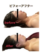 ミクロスポーツ整骨院(MICRO SPORTS整骨院)/【befor/after】20代〔たるみ〕