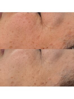 ヴェルシック(Belchic)/くすみを解消しシミも改善&予防