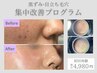 【目立ち毛穴卒業】毛穴改善パッケージの初回体験￥4,980
