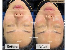 フローラル ビューティー(Floral-Beauty)/【ビフォーアフター】小顔エステ