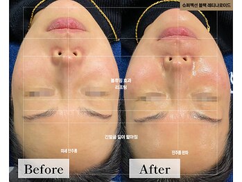 フローラル ビューティー(Floral-Beauty)/【ビフォーアフター】小顔エステ