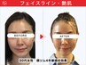※選択不可:【Before&After】再来限定5名様!小顔矯正+ヘッドスパ