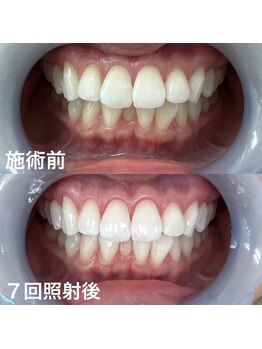 ホワイトニングサロン 京都烏丸店/ホワイトニング施術前