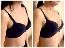 プリマ(prima)/バストアップ症例