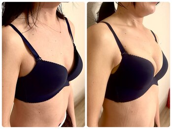 プリマ(prima)/バストアップ症例