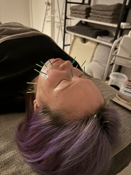 ラフテル鍼灸整骨院/南船場エリアで人気の美容鍼♪