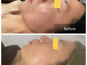 トータルビューティ リライフ(Total beauty Relife)/ハーブピーリングセラム延髄