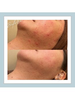 ラシュレ(BEAUTY CONCIERGE RASSURER)/ニキビ、赤み、凸凹にND-R！