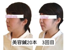 アネモネ 心斎橋院/フェイスラインスッキリ！