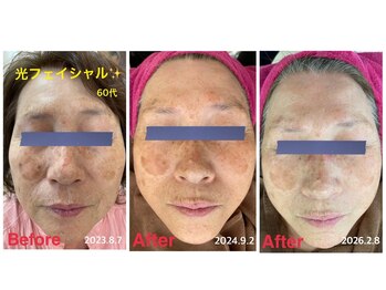 ソレイユ/光フェイシャルでの効果!