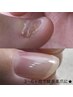 人前で手を出したくない方へ|深爪・割れ爪・ボロボロ爪改善育成体験