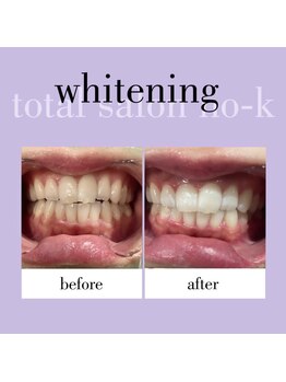 ヌック(NO-K)/ホワイトニング