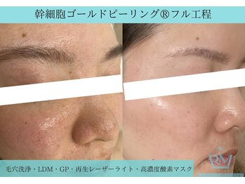 リメイククリニカルビューティー(Remake clinical beauty)/毛穴撲滅