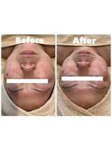 ティアラ(TIARA)/【小顔、たるみ】テラボーラー