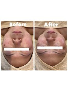 ティアラ(TIARA)/【小顔、たるみ】テラボーラー